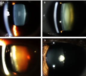 Shows a small congenital cataract (A), a nuclear cataract (B), dense nuclear cataract (C) and posterior sub-capsular cataract (D). In images A-C you can see a beam of light to the left of the image.