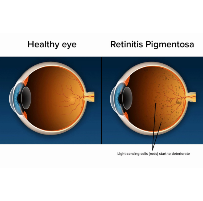 Healthy eye and retinitis pigmentosa